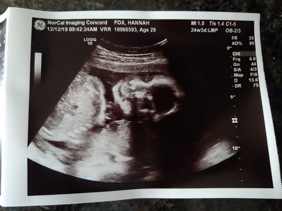 Ultrasound picture